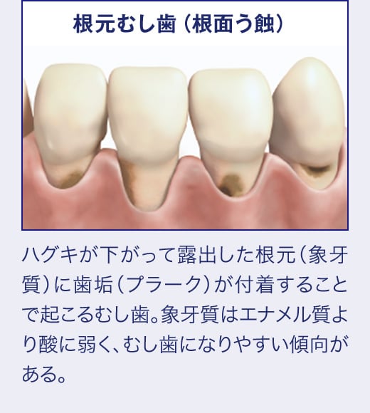 根元むし歯(根面う蝕)ハグキが下がって露出した根元(象牙質)に歯垢(プラーク)が付着することで起こるむし歯。象牙質はエナメル質より酸に弱く、むし歯になりやすい傾向がある。