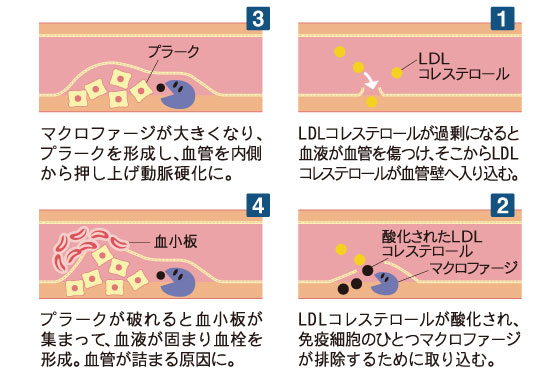 「抗酸化ビタミン」で動脈硬化を予防しよう