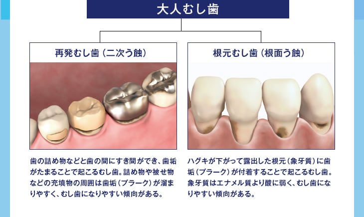 大人むし歯 再発むし歯(二次う蝕)歯の詰め物などと歯の間にすき間ができ、歯垢がたまることで起こるむし歯。詰め物や被せ物などの充填物の周囲は歯垢(プラーク)が溜まりやすく、むし歯になりやすい傾向がある。 根元むし歯(根面う蝕) ハグキが下がって露出した根元(象牙質)に歯垢(プラーク)が付着することで起こるむし歯。象牙質はエナメル質より酸に弱く、むし歯になりやすい傾向がある。