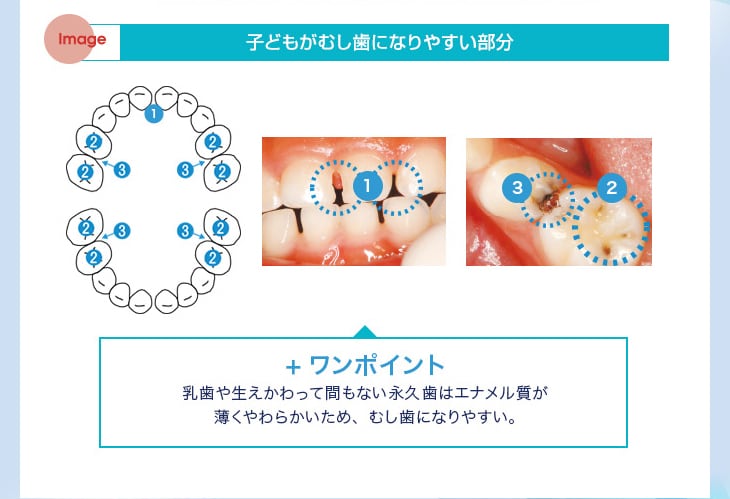 子どもがむし歯になりやすい部分+ワンポイント 乳歯や生えかわって間もない永久歯はエナメル質が薄くやわらかいため、むし歯になりやすい。