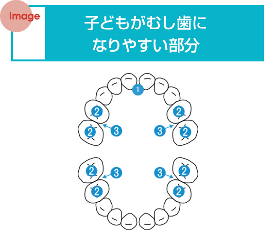 子どもがむし歯になりやすい部分