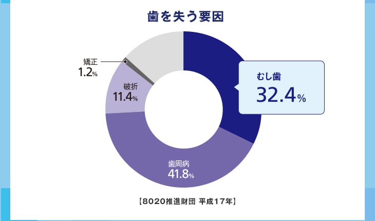 歯を失う要因 むし歯32.4% 歯周病41.8% 破折11.4% 矯正1.2%【8020推進財団 平成17年】