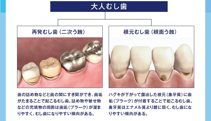 大人むし歯 再発むし歯(二次う蝕)歯の詰め物などと歯の間にすき間ができ、歯垢がたまることで起こるむし歯。詰め物や被せ物などの充填物の周囲は歯垢(プラーク)が溜まりやすく、むし歯になりやすい傾向がある。根元むし歯(根面う蝕)ハグキが下がって露出した根元(象牙質)に歯垢(プラーク)が付着することで起こるむし歯。象牙質はエナメル質より酸に弱く、むし歯になりやすい傾向がある。