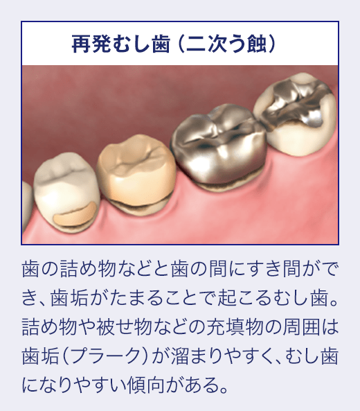 再発むし歯(二次う蝕)歯の詰め物などと歯の間にすき間ができ、歯垢がたまることで起こるむし歯。詰め物や被せ物などの充填物の周囲は歯垢(プラーク)が溜まりやすく、むし歯になりやすい傾向がある。