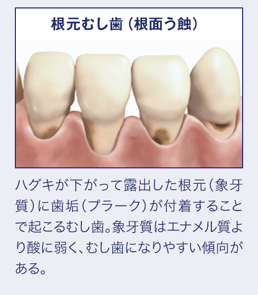 根元むし歯(根面う蝕)ハグキが下がって露出した根元(象牙質)に歯垢(プラーク)が付着することで起こるむし歯。象牙質はエナメル質より酸に弱く、むし歯になりやすい傾向がある。