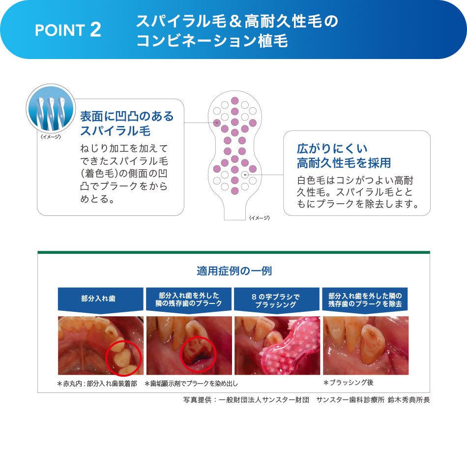 スパイラル毛＆高耐久性毛のコンビネーション植毛