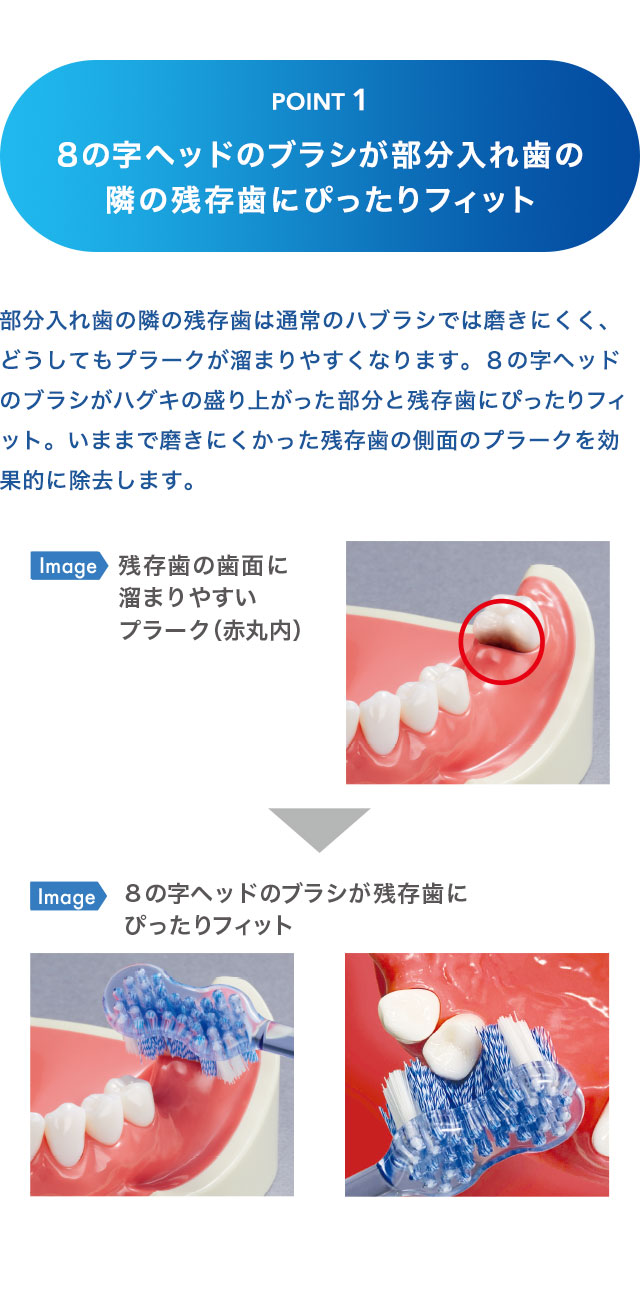 ８の字ヘッドのブラシが部分入れ歯の隣の残存歯にぴったりフィット